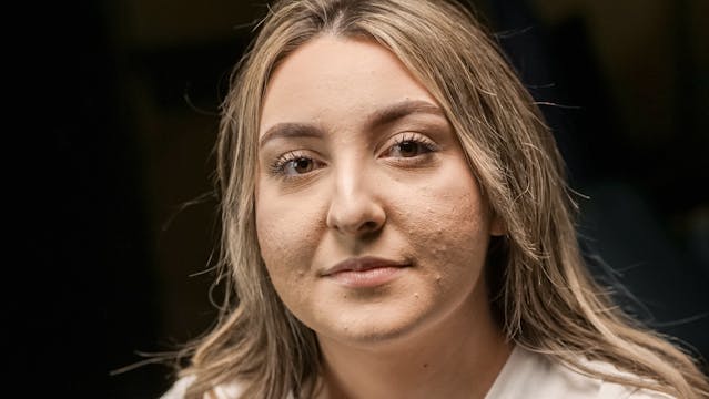 pattanásos hegek eltüntetése lézerrel Pécsen